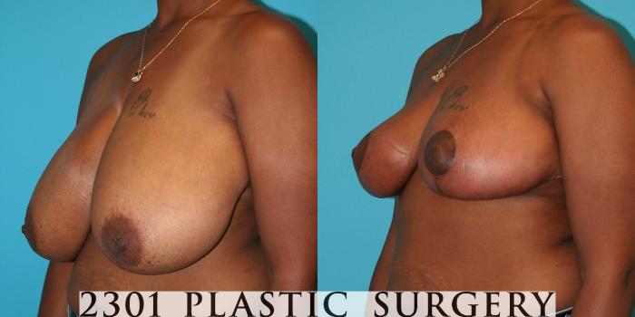 Before & After Breast Reduction Case 31 View #2 View in Fort Worth, Plano, & Frisco, Texas