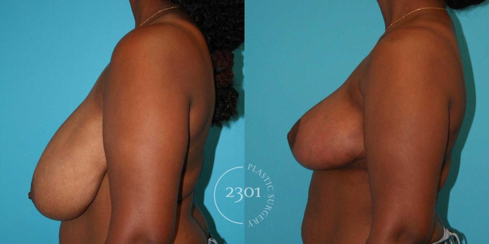 Before & After Breast Reduction Case 31 View #3 View in Fort Worth, Plano, & Frisco, Texas