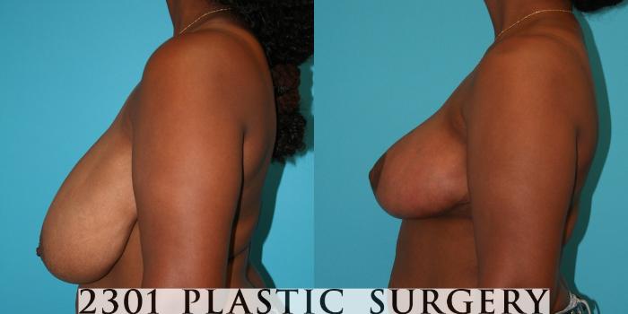 Before & After Breast Reduction Case 31 View #3 View in Fort Worth, Plano, & Frisco, Texas