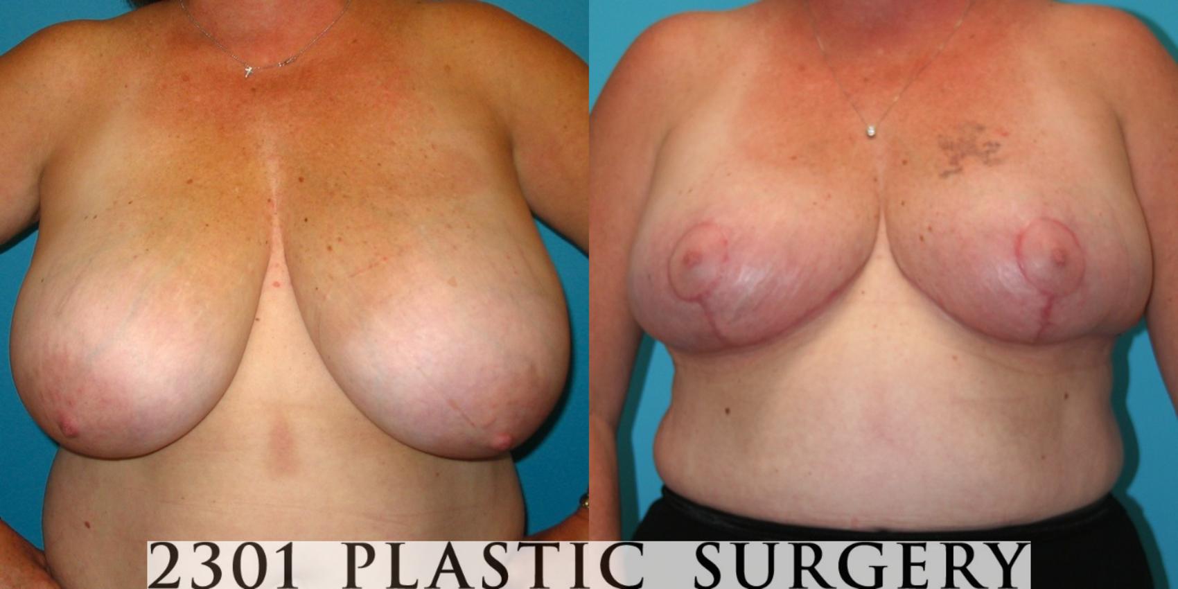 Before & After Breast Reduction Case 32 View #1 View in Fort Worth, Plano, & Frisco, Texas