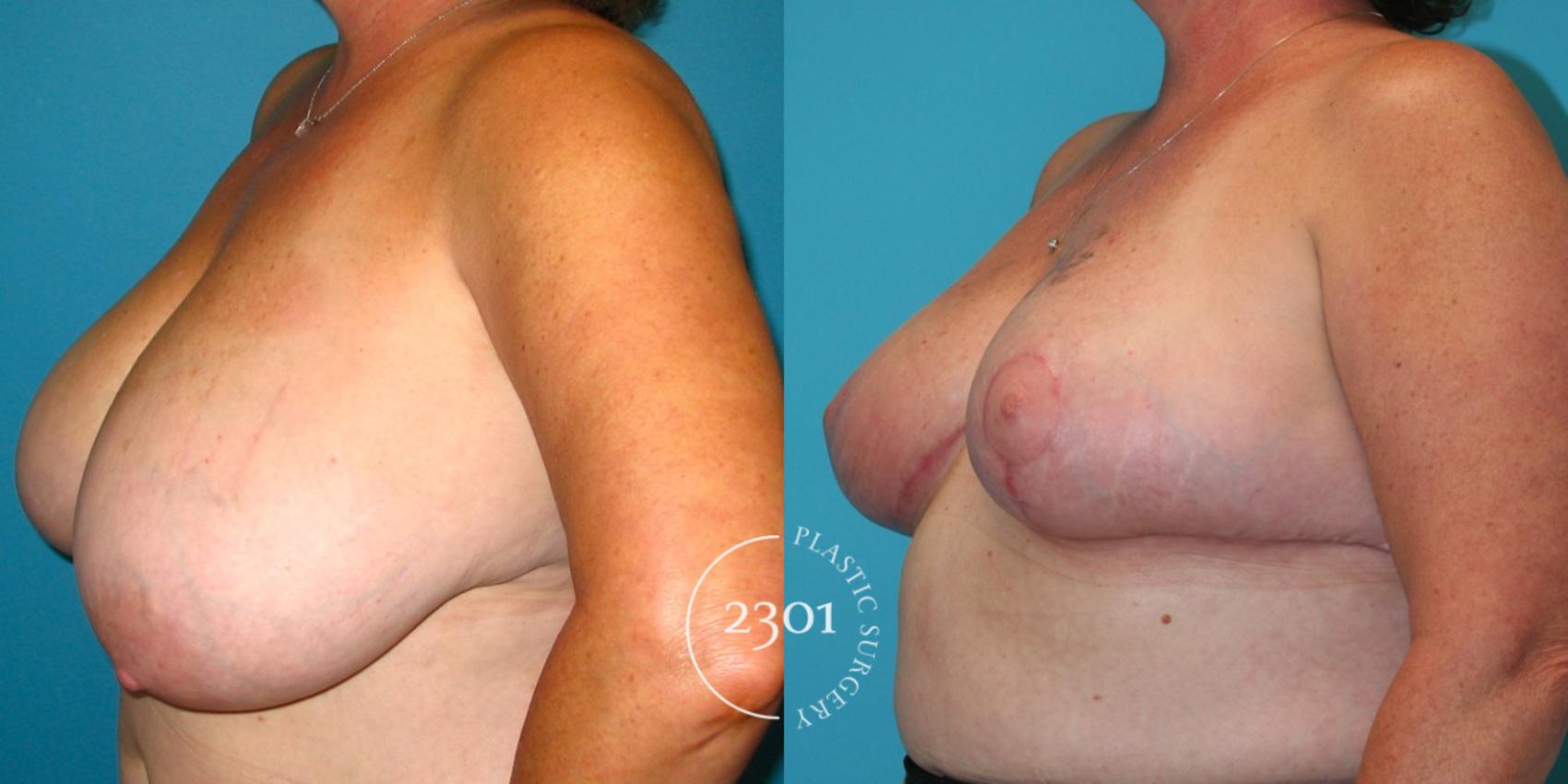 Before & After Breast Reduction Case 32 View #2 View in Fort Worth, Plano, & Frisco, Texas