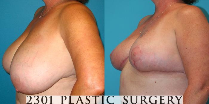 Before & After Breast Reduction Case 32 View #2 View in Fort Worth, Plano, & Frisco, Texas
