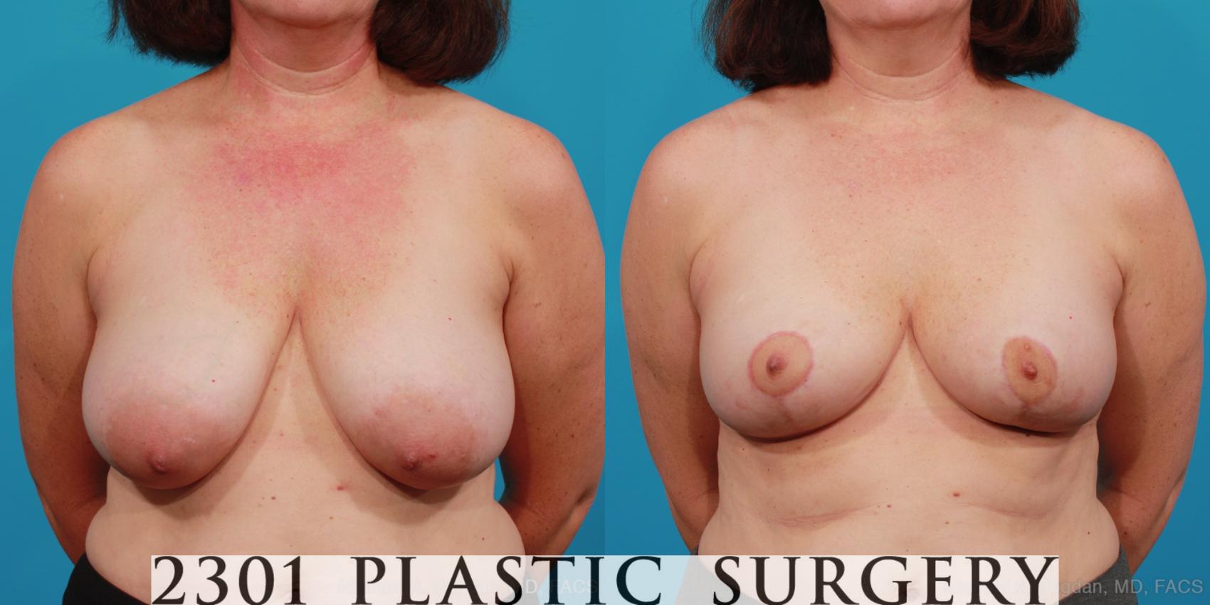 Before & After Breast Reduction Case 327 View #1 View in Fort Worth & Frisco, Texas