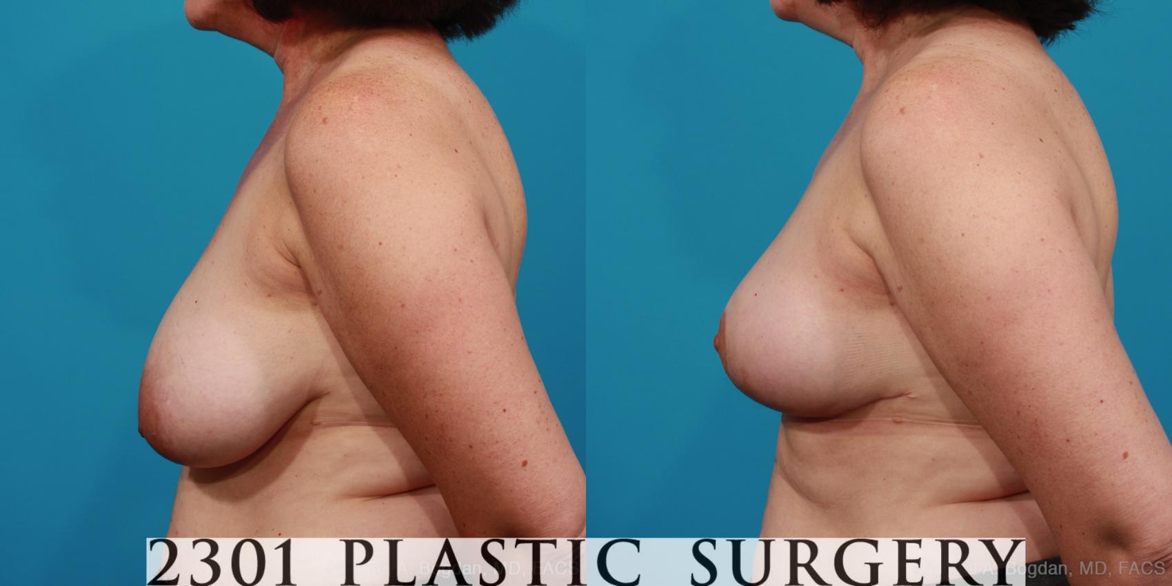 Before & After Breast Reduction Case 327 View #2 View in Fort Worth & Frisco, Texas