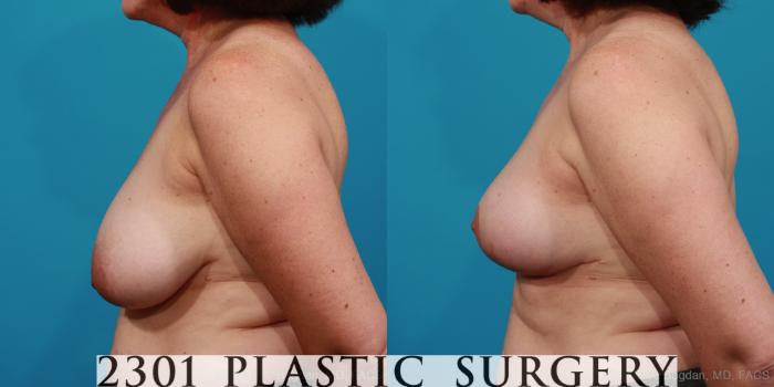 Before & After Breast Reduction Case 327 View #2 View in Fort Worth, Plano, & Frisco, Texas