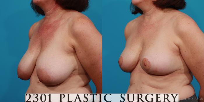 Before & After Breast Reduction Case 327 View #3 View in Fort Worth, Plano, & Frisco, Texas