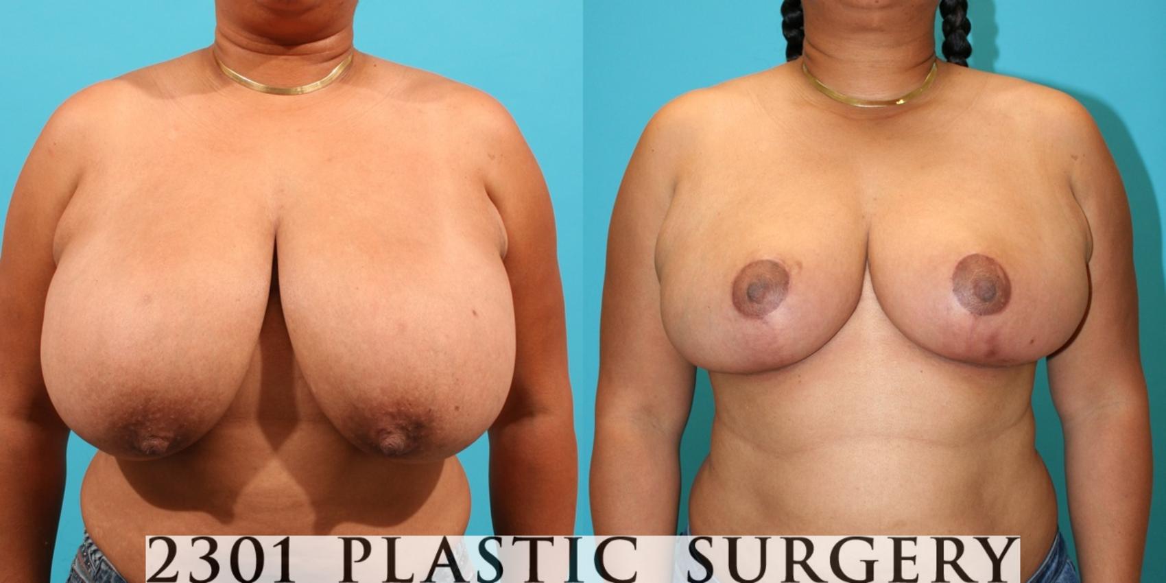 Before & After Breast Reduction Case 33 View #1 View in Fort Worth, Plano, & Frisco, Texas