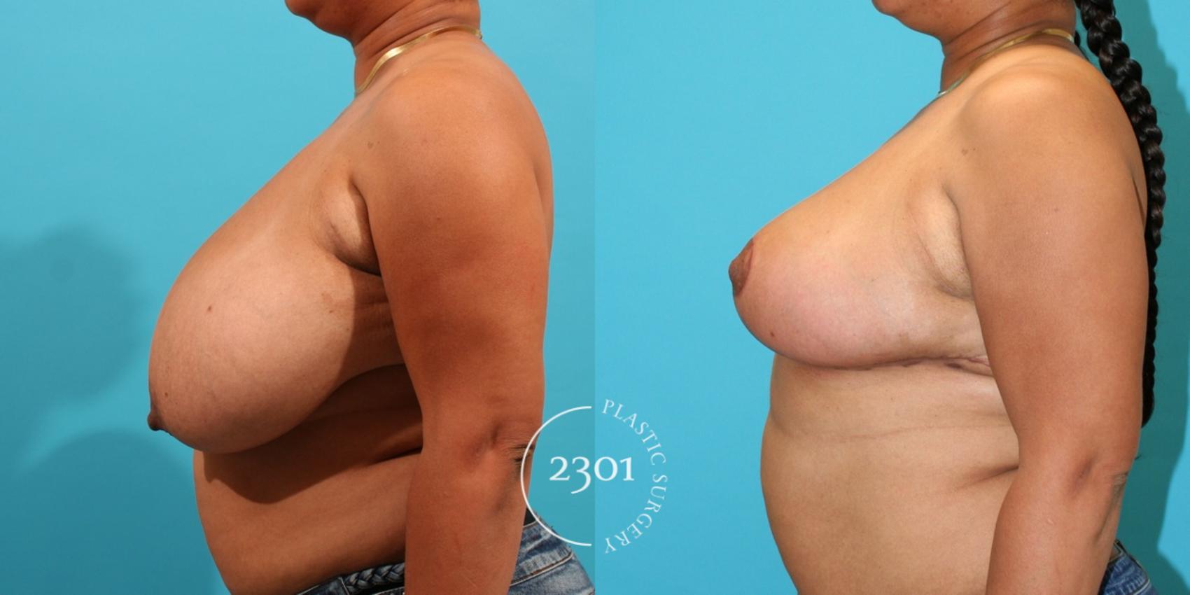 Before & After Breast Reduction Case 33 View #2 View in Fort Worth, Plano, & Frisco, Texas