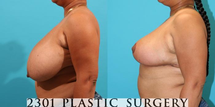Before & After Breast Reduction Case 33 View #2 View in Fort Worth, Plano, & Frisco, Texas