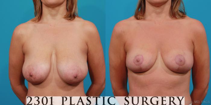 Before & After Breast Reduction Case 331 View #1 View in Fort Worth, Plano, & Frisco, Texas