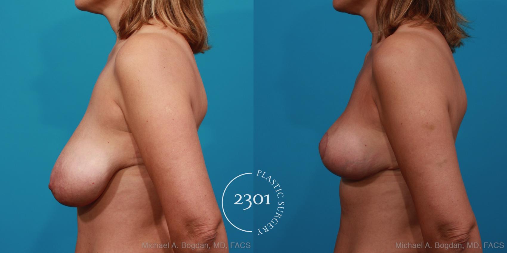 Before & After Breast Reduction Case 331 View #2 View in Fort Worth, Plano, & Frisco, Texas