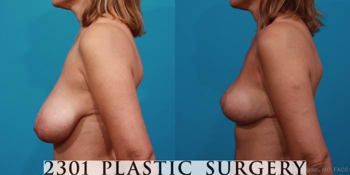 Before & After Breast Reduction Case 331 View #2 View in Fort Worth, Plano, & Frisco, Texas