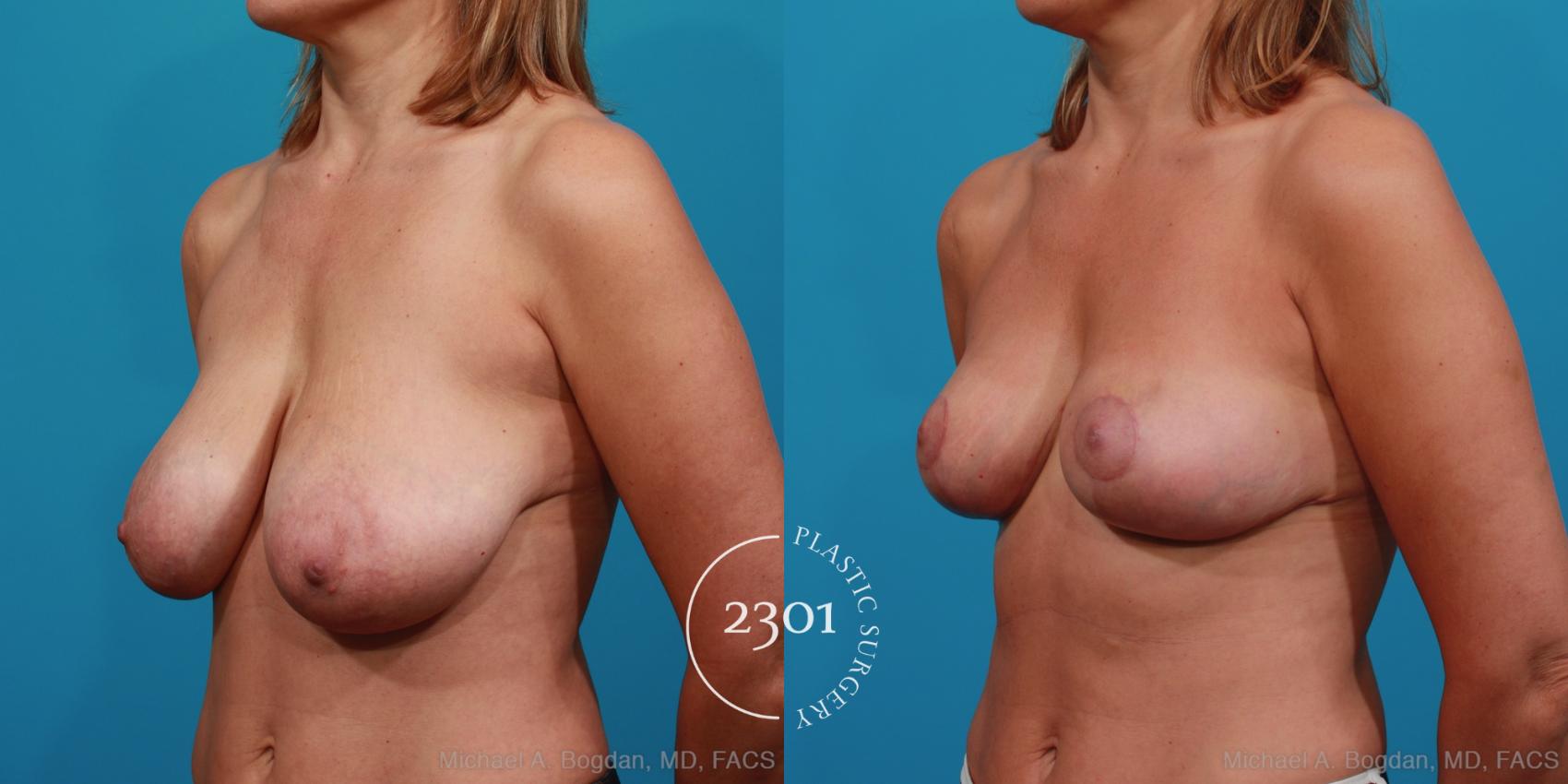 Before & After Breast Reduction Case 331 View #3 View in Fort Worth, Plano, & Frisco, Texas