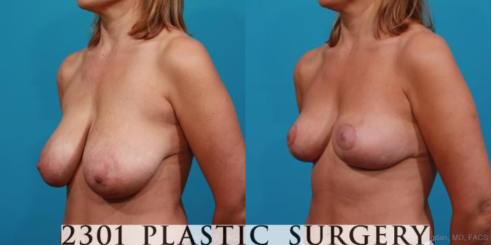 Before & After Breast Reduction Case 331 View #3 View in Fort Worth, Plano, & Frisco, Texas