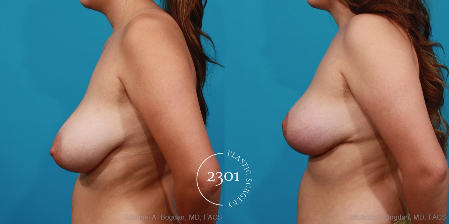 Before & After Breast Reduction Case 343 View #2 View in Fort Worth, Plano, & Frisco, Texas