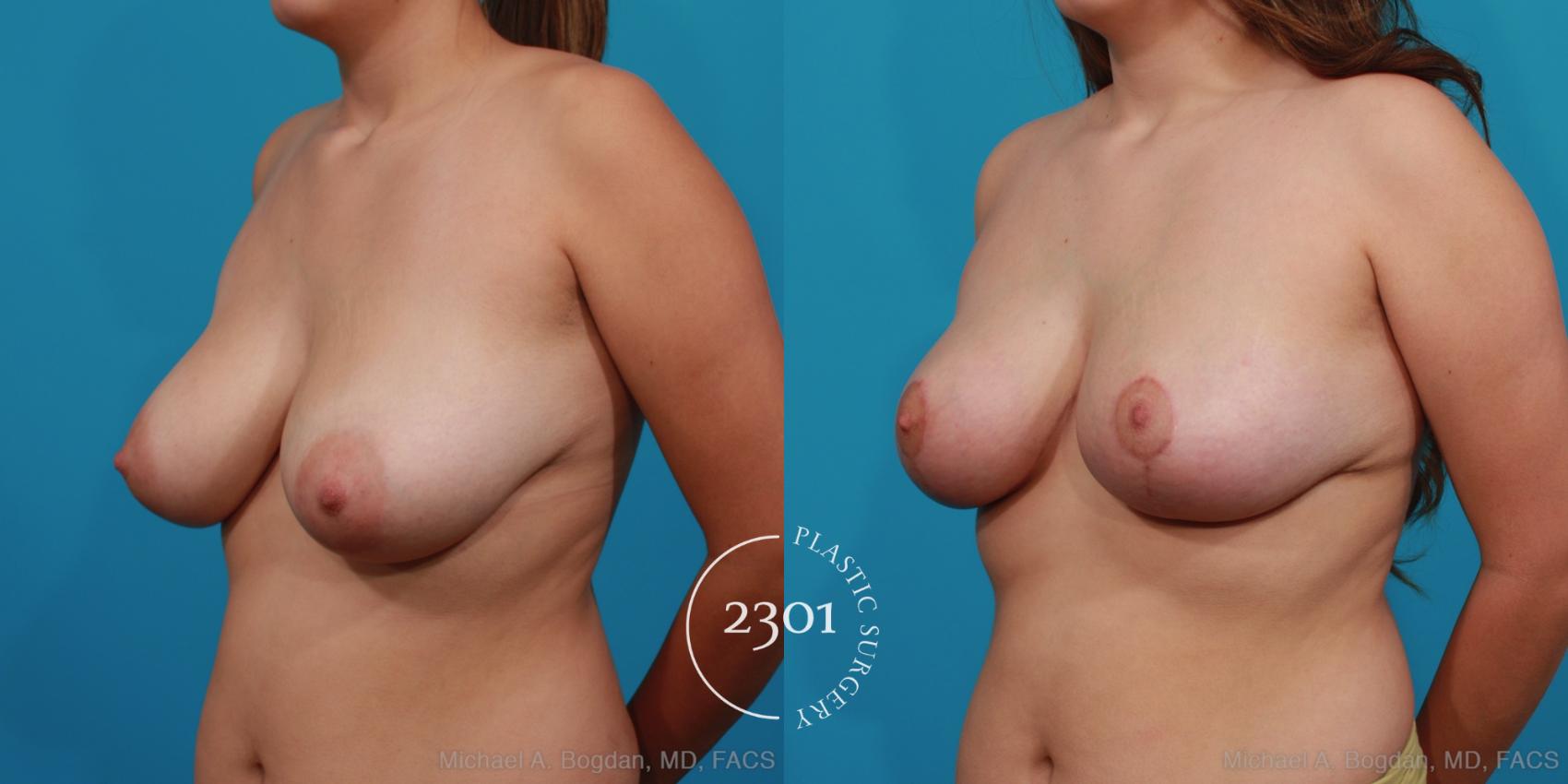 Before & After Breast Reduction Case 343 View #3 View in Fort Worth, Plano, & Frisco, Texas