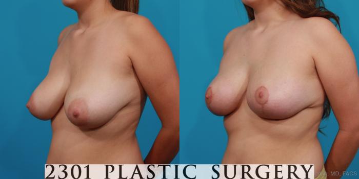 Before & After Breast Reduction Case 343 View #3 View in Fort Worth, Plano, & Frisco, Texas