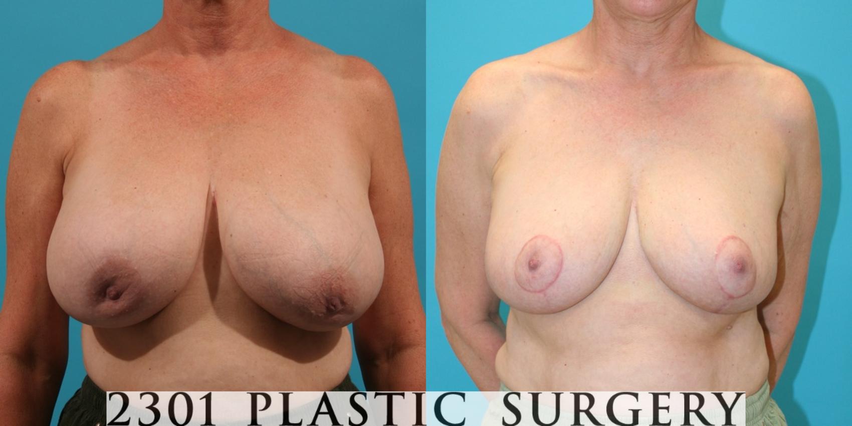 Before & After Breast Reduction Case 36 View #1 View in Fort Worth, Plano, & Frisco, Texas