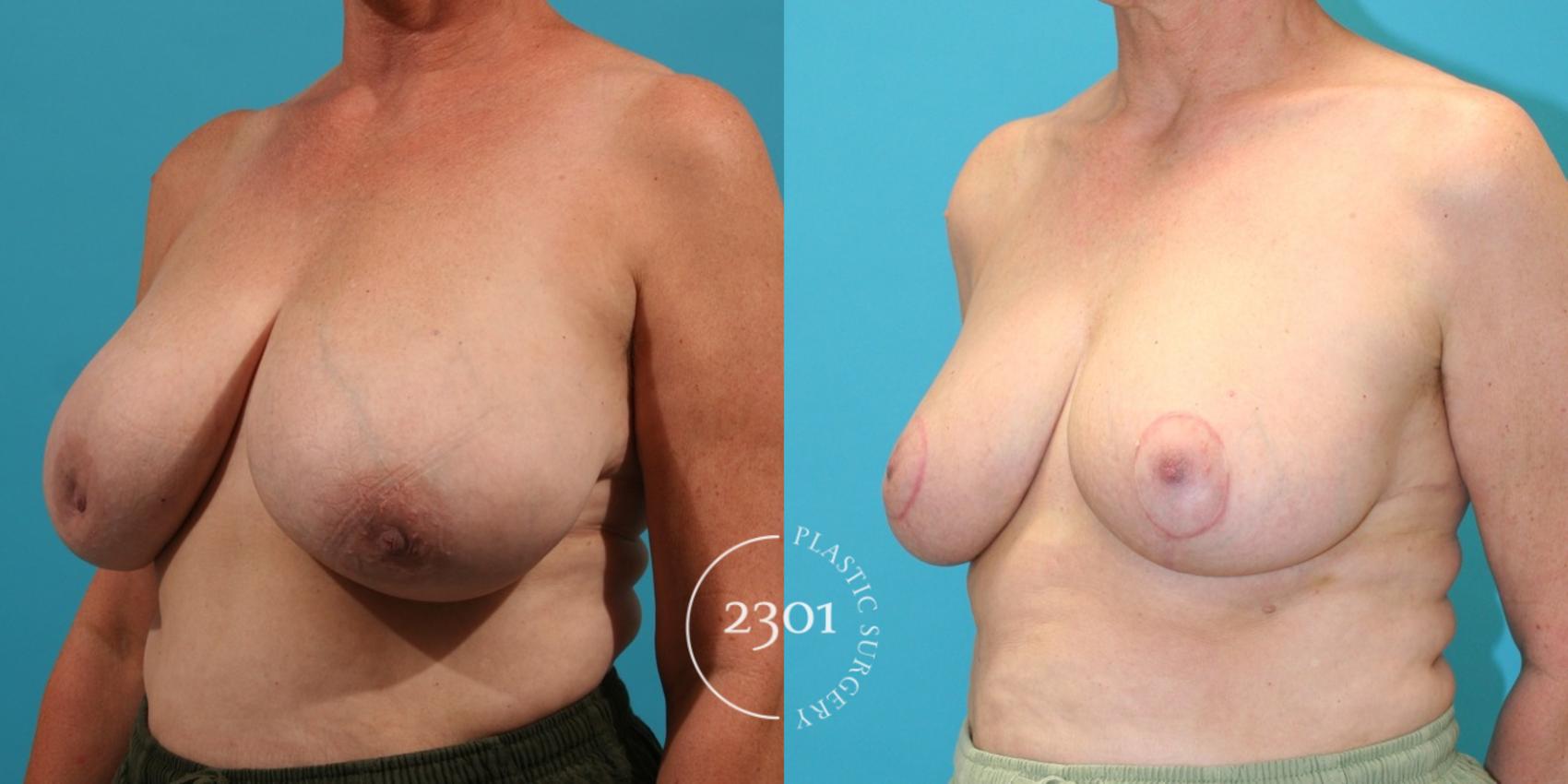 Before & After Breast Reduction Case 36 View #2 View in Fort Worth, Plano, & Frisco, Texas