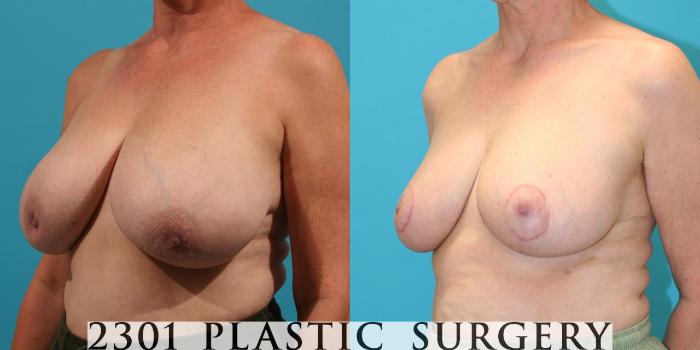 Before & After Breast Reduction Case 36 View #2 View in Fort Worth, Plano, & Frisco, Texas