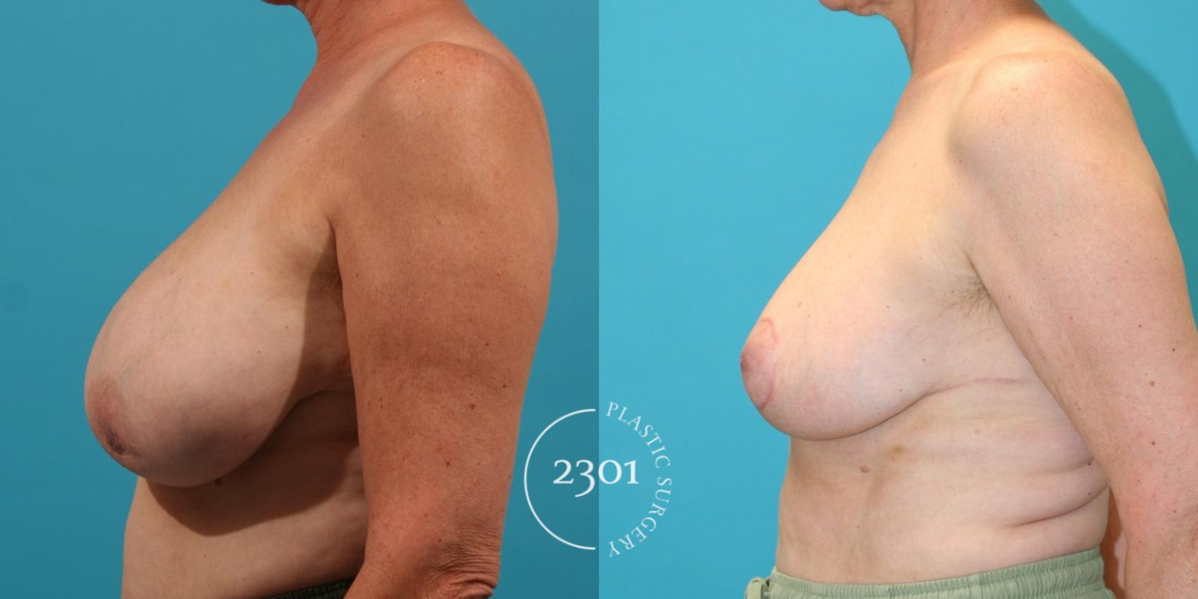 Before & After Breast Reduction Case 36 View #3 View in Fort Worth, Plano, & Frisco, Texas