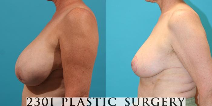 Before & After Breast Reduction Case 36 View #3 View in Fort Worth, Plano, & Frisco, Texas