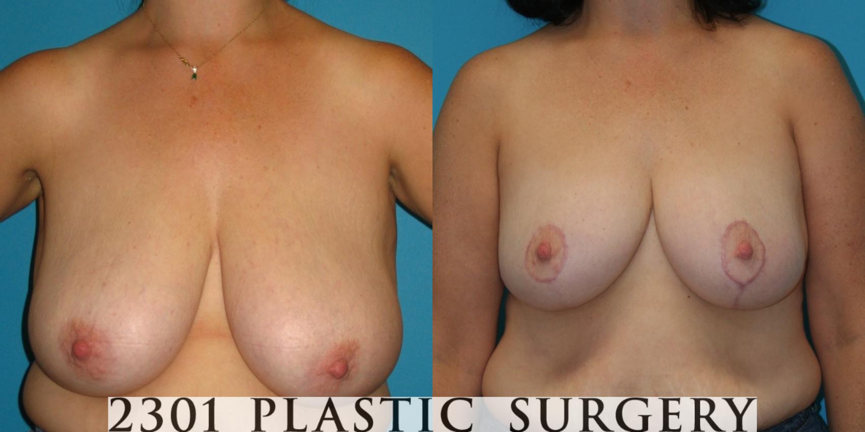 Before & After Breast Reduction Case 37 View #1 View in Fort Worth & Frisco, Texas