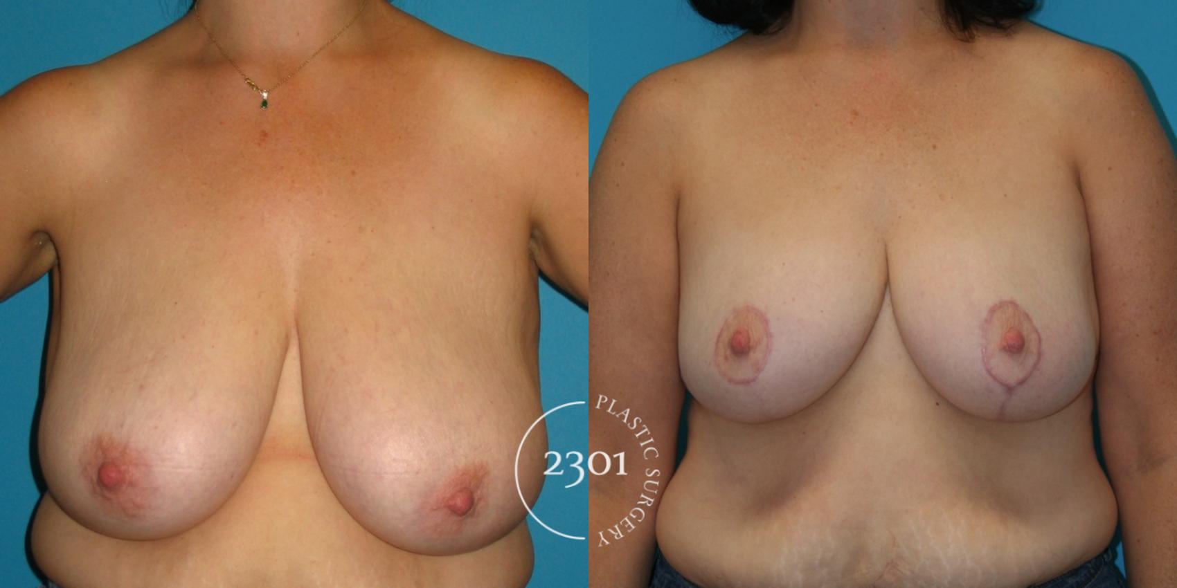 Before & After Breast Reduction Case 37 View #1 View in Fort Worth, Plano, & Frisco, Texas