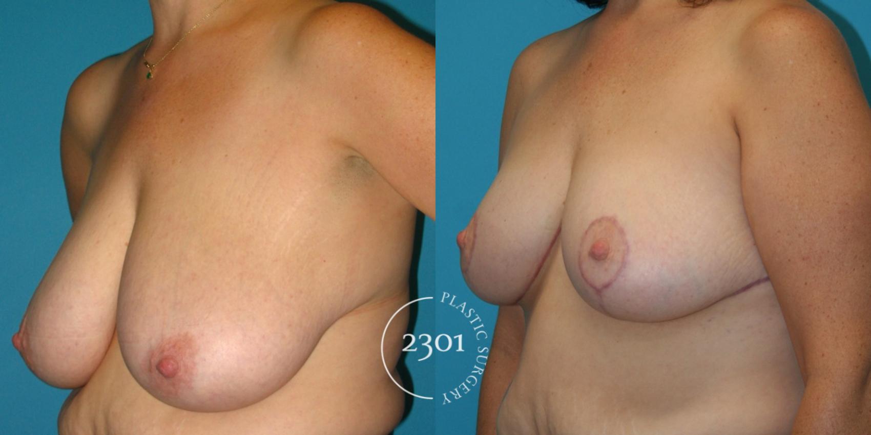 Before & After Breast Reduction Case 37 View #2 View in Fort Worth, Plano, & Frisco, Texas