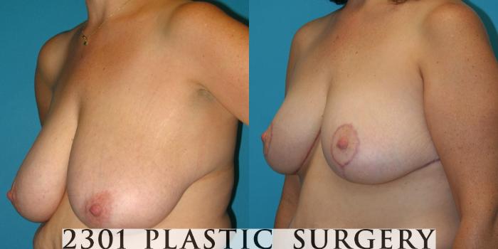 Before & After Breast Reduction Case 37 View #2 View in Fort Worth, Plano, & Frisco, Texas