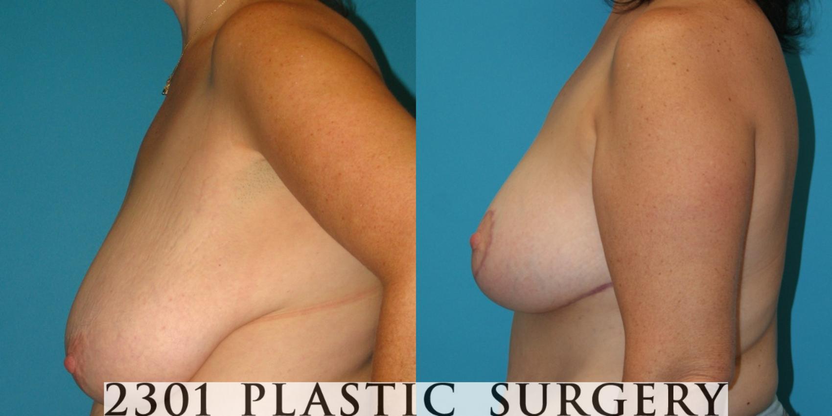 Before & After Breast Reduction Case 37 View #3 View in Fort Worth & Frisco, Texas
