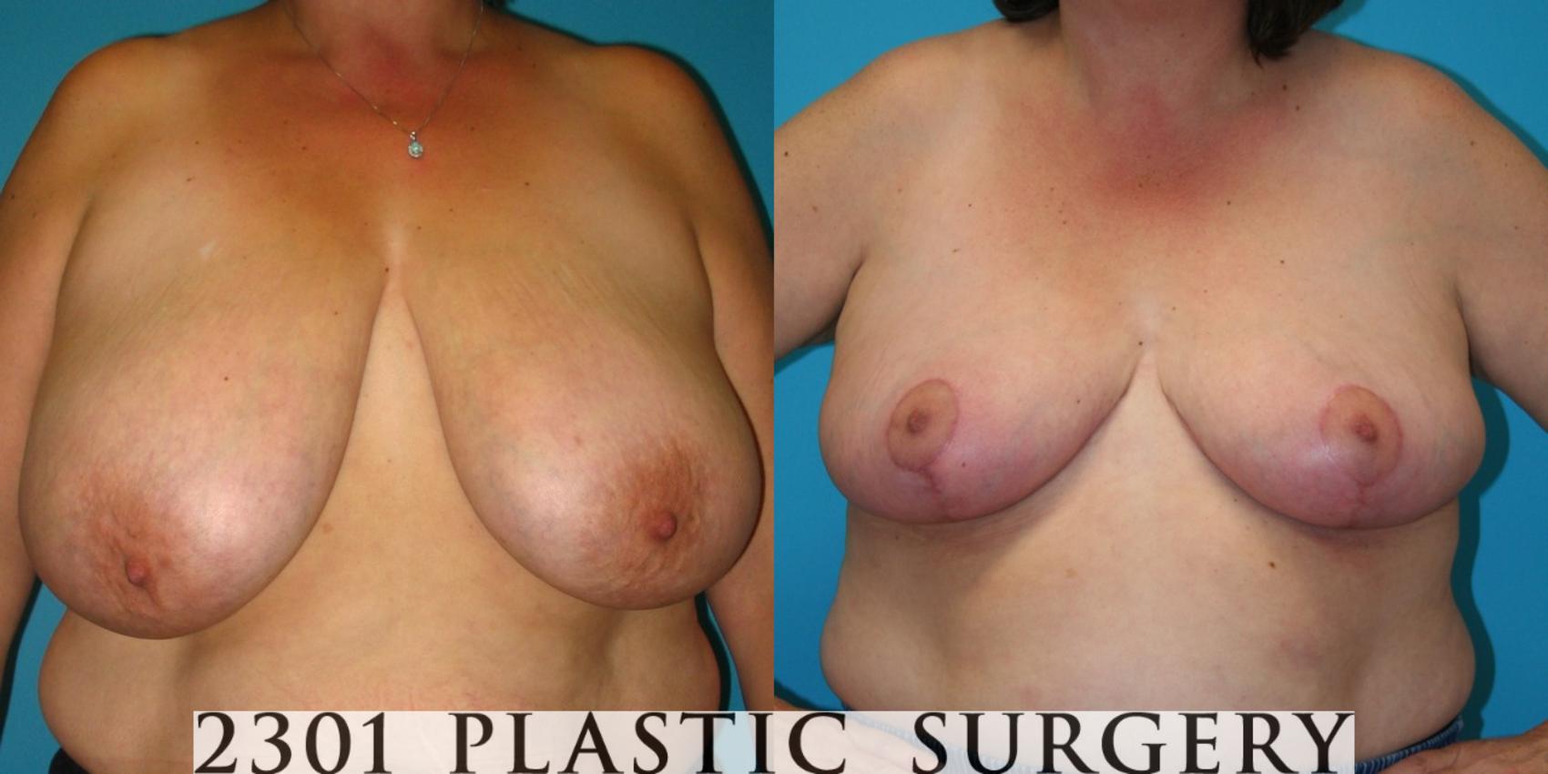 Before & After Breast Reduction Case 39 View #1 View in Fort Worth, Plano, & Frisco, Texas