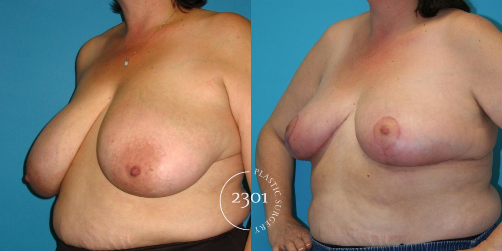 Before & After Breast Reduction Case 39 View #2 View in Fort Worth, Plano, & Frisco, Texas