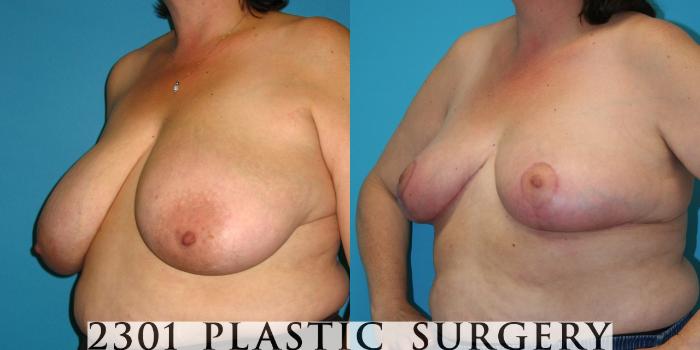 Before & After Breast Reduction Case 39 View #2 View in Fort Worth, Plano, & Frisco, Texas