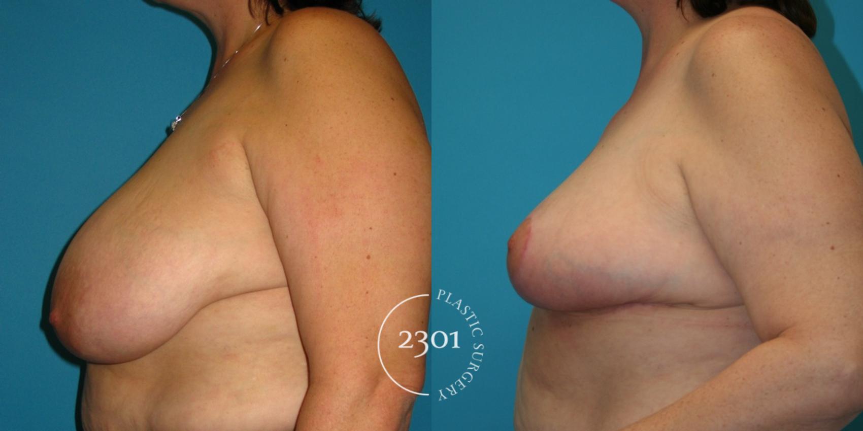 Before & After Breast Reduction Case 39 View #3 View in Fort Worth, Plano, & Frisco, Texas
