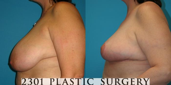 Before & After Breast Reduction Case 39 View #3 View in Fort Worth, Plano, & Frisco, Texas