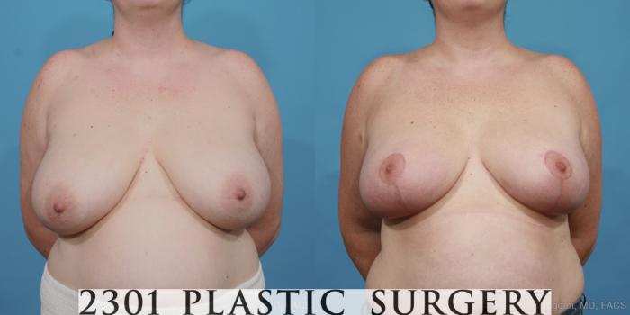 Before & After Breast Reduction Case 418 View #1 View in Fort Worth, Plano, & Frisco, Texas
