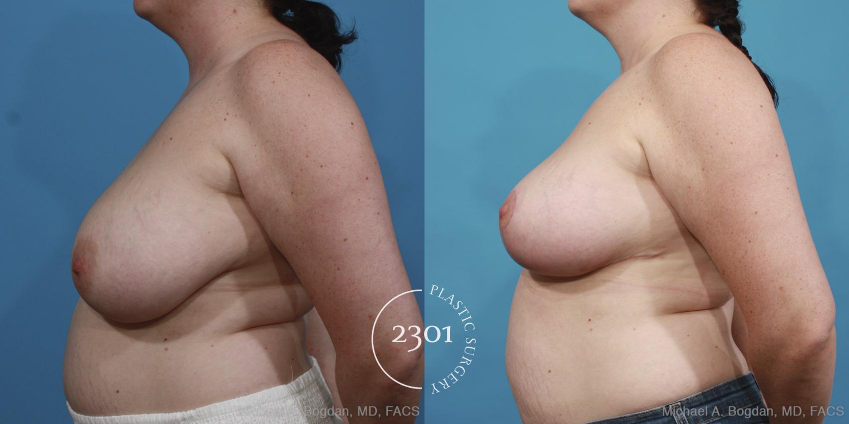 Before & After Breast Reduction Case 418 View #2 View in Fort Worth, Plano, & Frisco, Texas