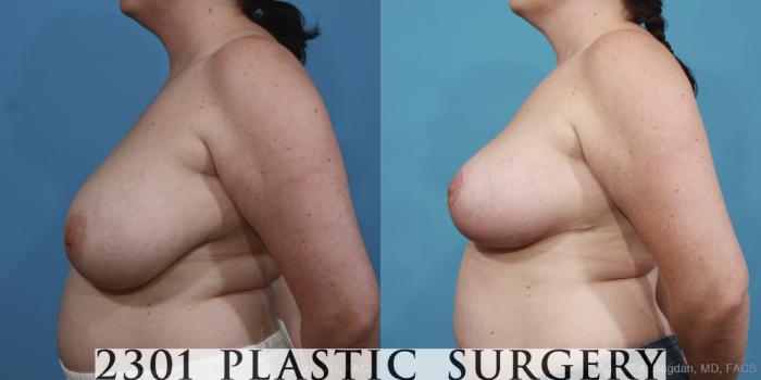 Before & After Breast Reduction Case 418 View #2 View in Fort Worth, Plano, & Frisco, Texas