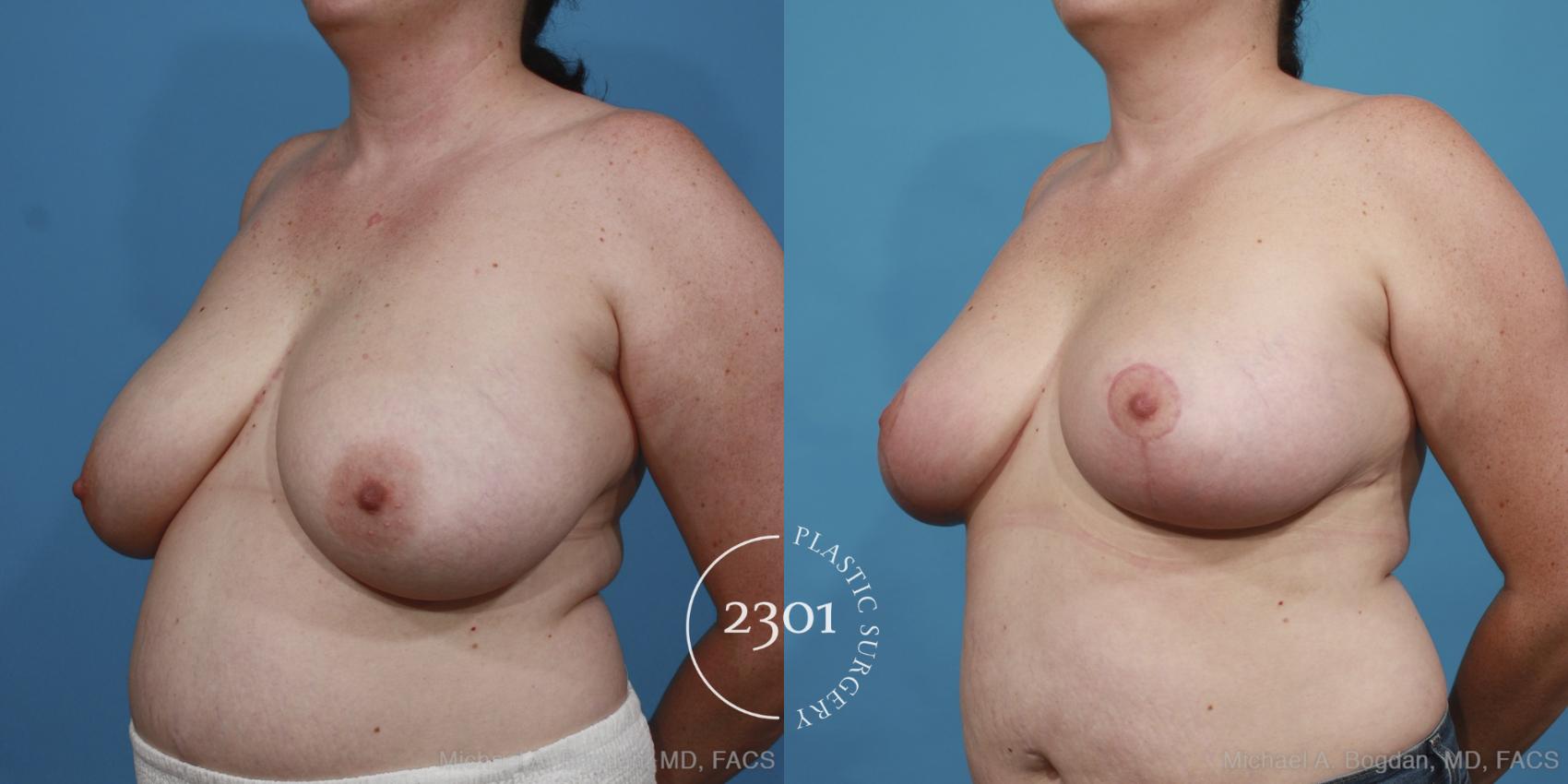 Before & After Breast Reduction Case 418 View #3 View in Fort Worth, Plano, & Frisco, Texas
