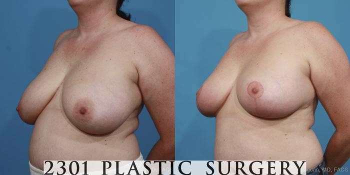 Before & After Breast Reduction Case 418 View #3 View in Fort Worth, Plano, & Frisco, Texas