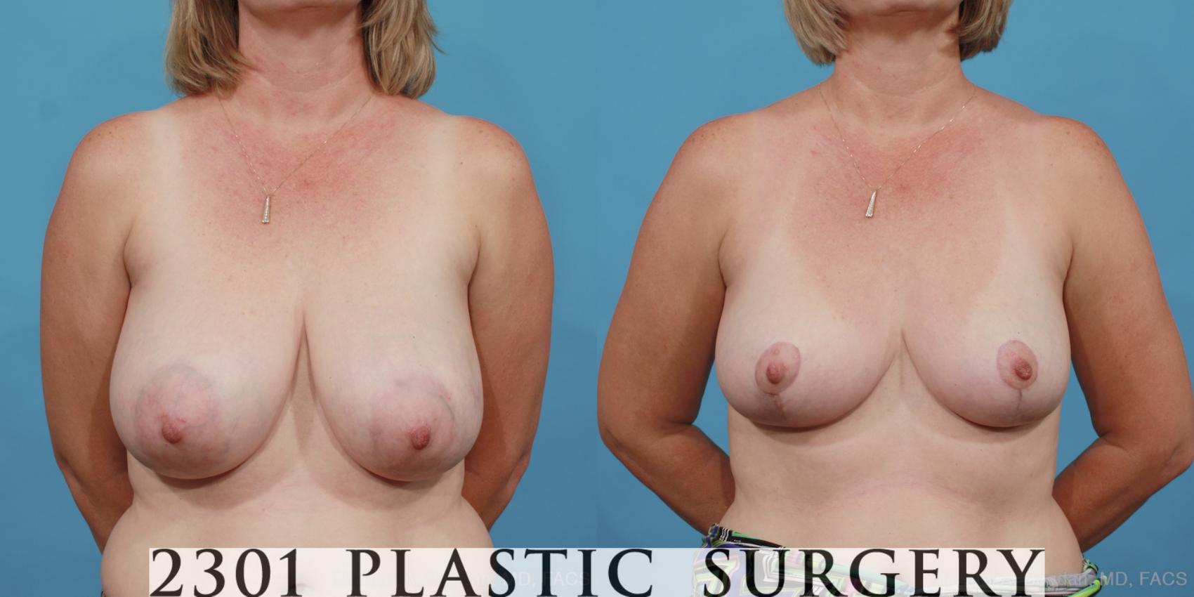 Before & After Breast Reduction Case 458 View #1 View in Fort Worth & Frisco, Texas