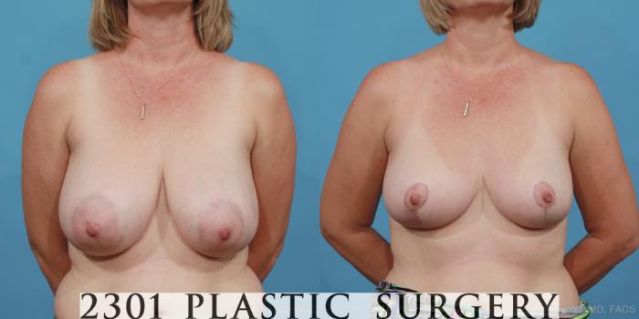 Before & After Breast Reduction Case 458 View #1 View in Fort Worth, Plano, & Frisco, Texas