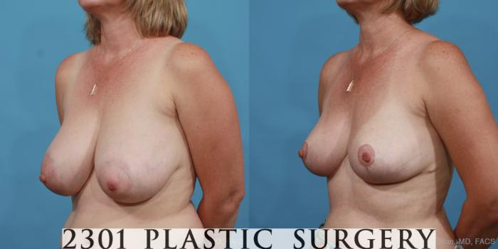 Before & After Breast Reduction Case 458 View #2 View in Fort Worth, Plano, & Frisco, Texas