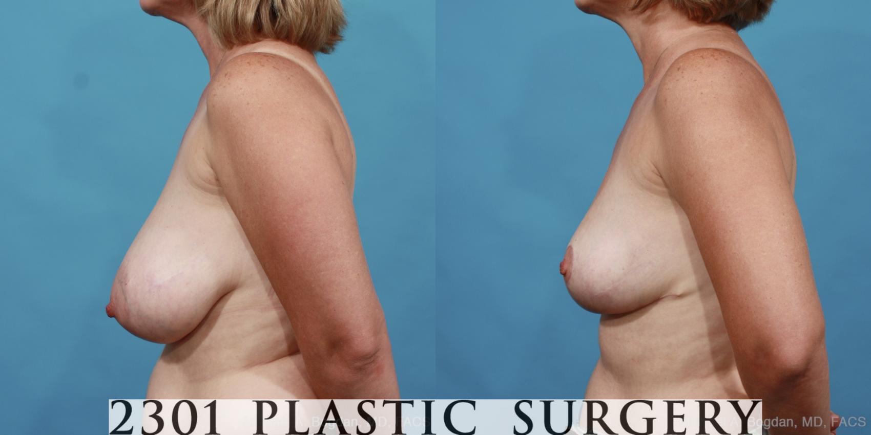 Before & After Breast Reduction Case 458 View #3 View in Fort Worth & Frisco, Texas
