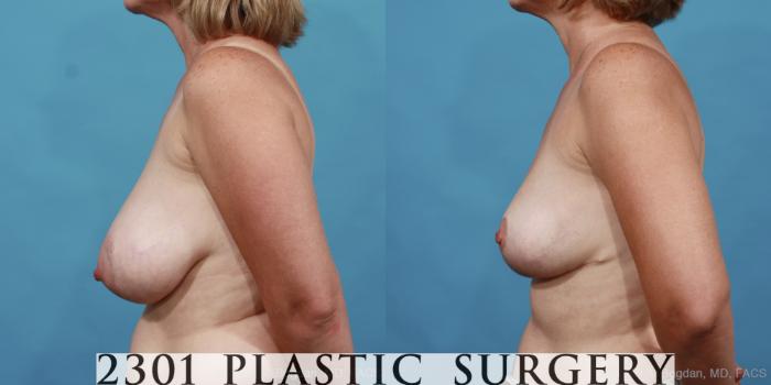 Before & After Breast Reduction Case 458 View #3 View in Fort Worth, Plano, & Frisco, Texas