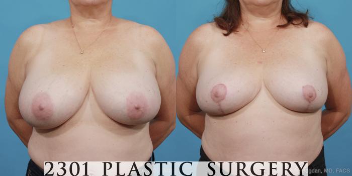 Before & After Breast Reduction Case 460 View #1 View in Fort Worth, Plano, & Frisco, Texas