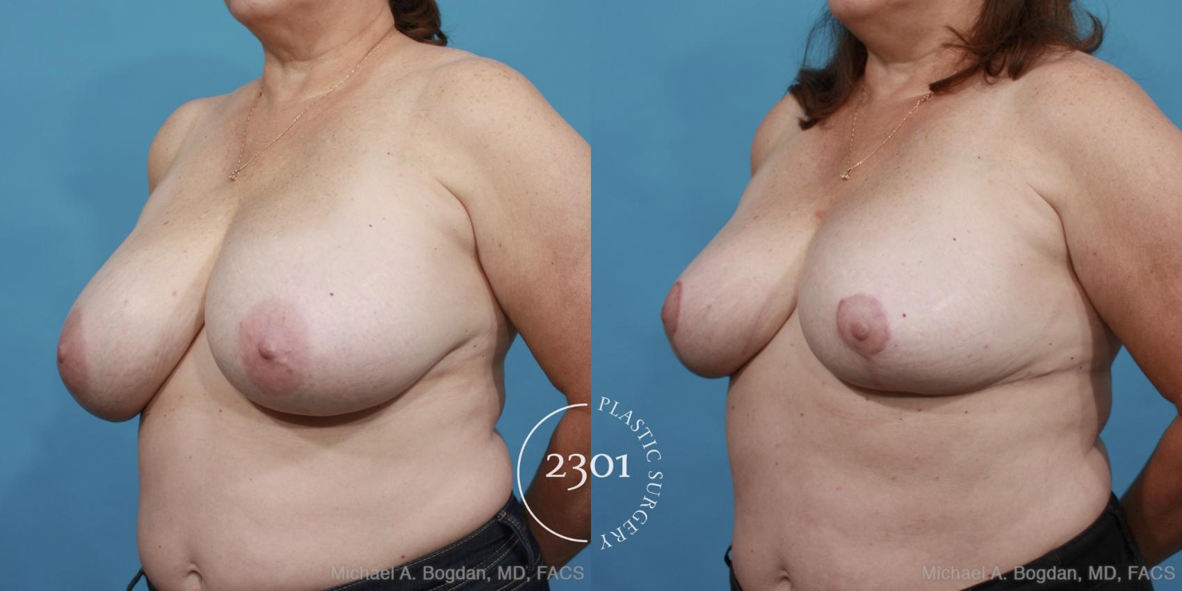 Before & After Breast Reduction Case 460 View #2 View in Fort Worth, Plano, & Frisco, Texas