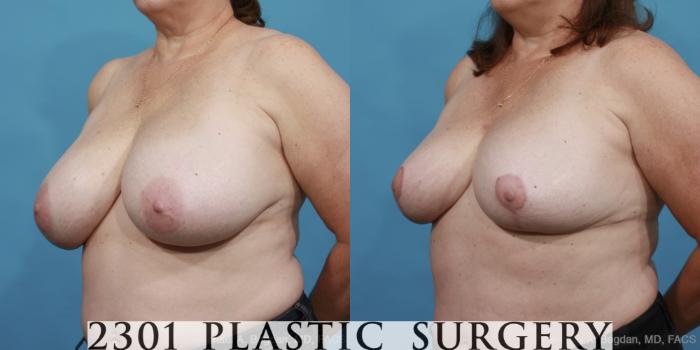 Before & After Breast Reduction Case 460 View #2 View in Fort Worth, Plano, & Frisco, Texas