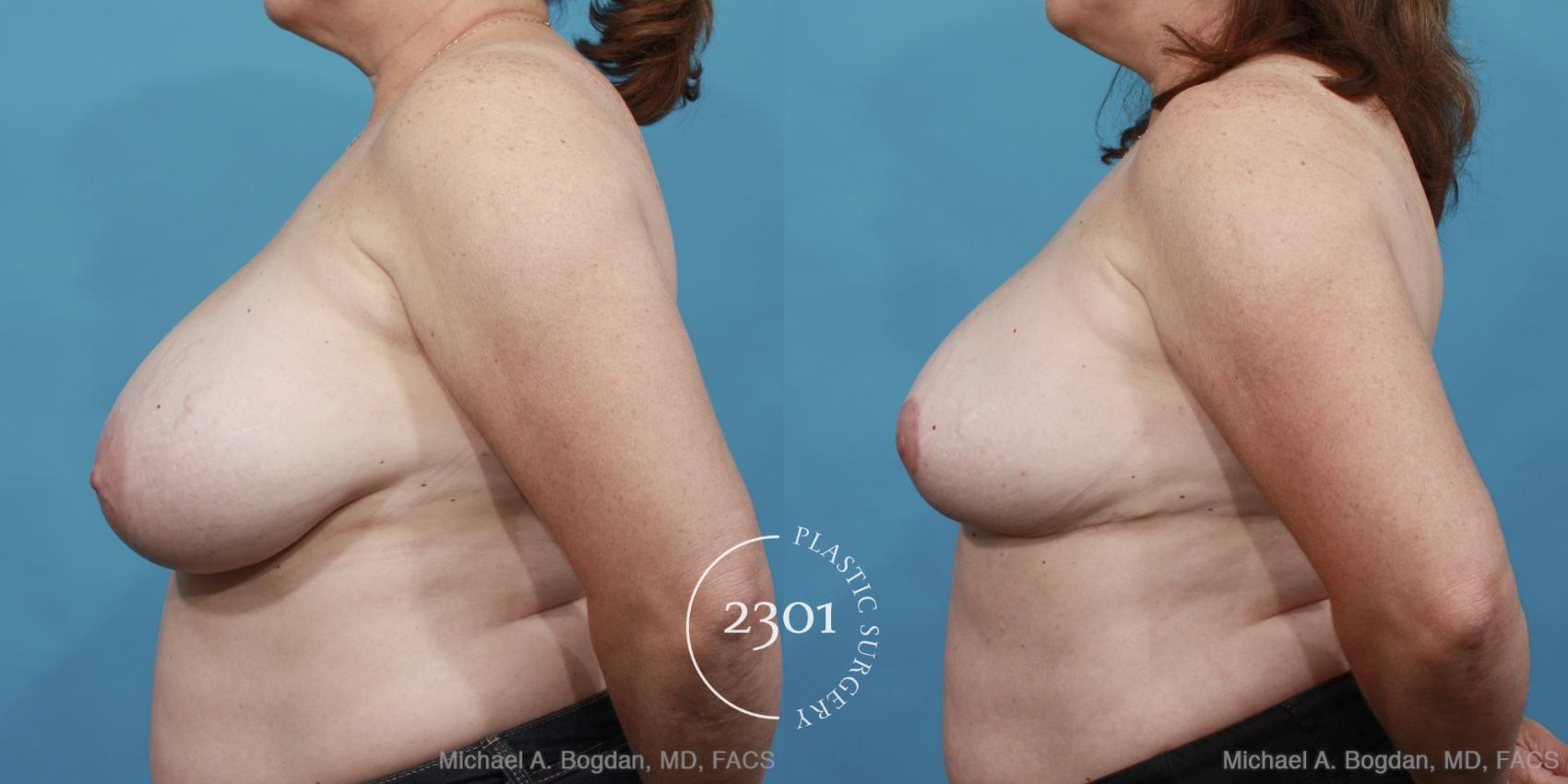 Before & After Breast Reduction Case 460 View #3 View in Fort Worth, Plano, & Frisco, Texas
